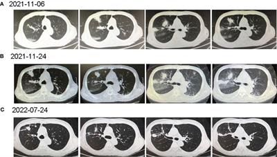 Rare tuberculosis in recipients of allogeneic hematopoietic stem cell transplantation successfully treated with contezolid–a typical case report and literature review